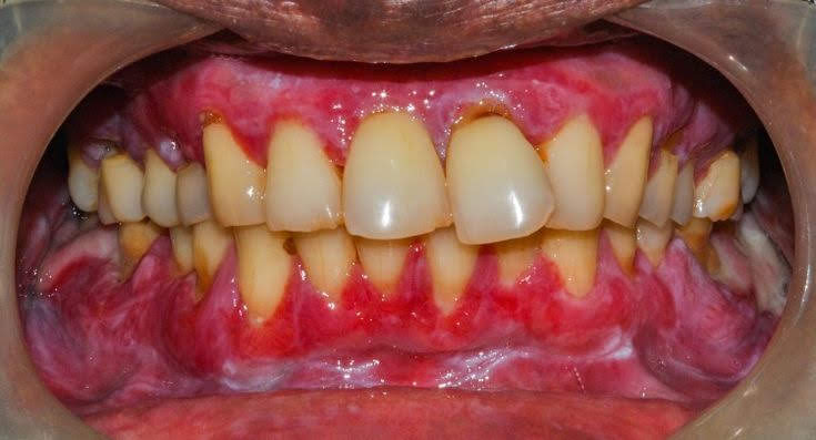 lichen planus on gums