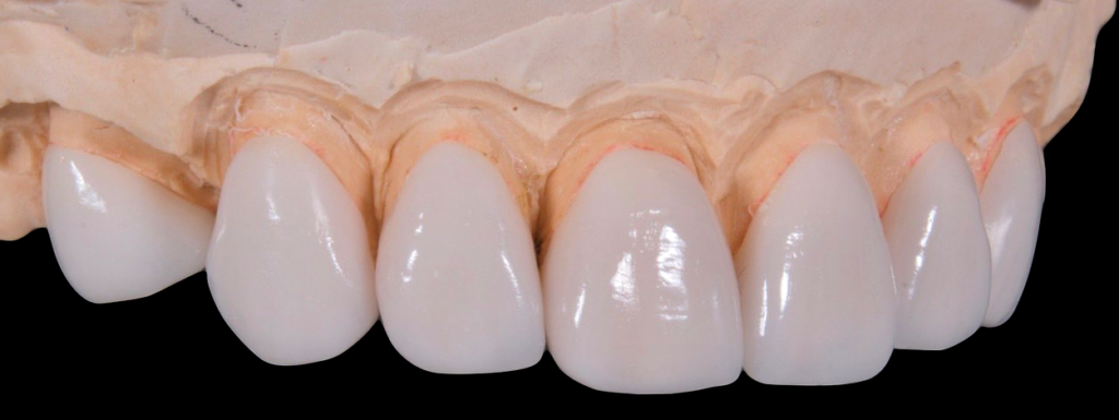 zirconia teeth